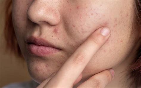 What Is The Healing Time For Acne Scars