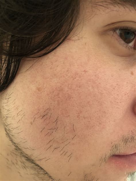 Help With Acne Scarring Scar Treatments