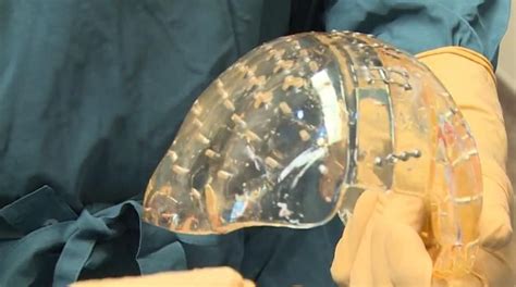 Surgeons Use 3 D Printer To Perform Worlds 1st Skull Transplant Video