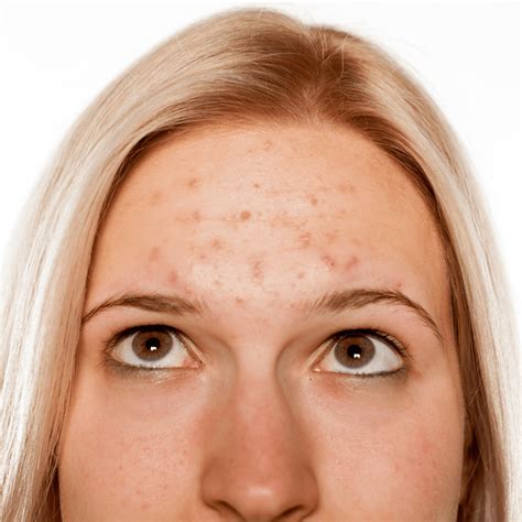 Discover Our Acne Treatment In Reading Crysallis Skin Clinic