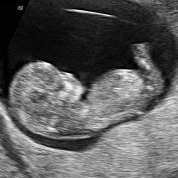 11 Weeks Pregnant: Symptoms with Images | Baby Development