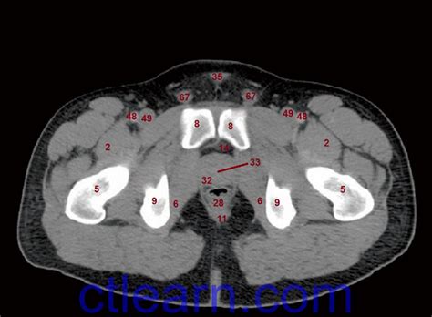 Ct Pelvis Anatomy Muscles Mri Anatomy Of Hip Joint Free Mri Axial