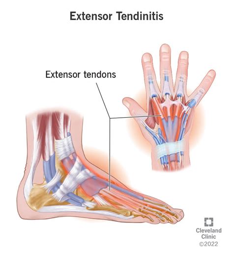 Top Stress Fracture Extensor Tendonitis Foot Swelling