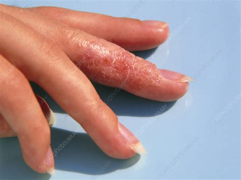 Eczema Affecting A Womanss Finger Stock Image M1500045 Science