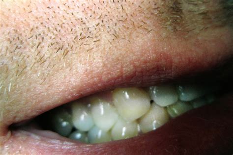 你嘴里的白斑是什么耳朵，鼻子，喉咙和牙齿问题文章身体和健康状况中心 雷竞技raybet官网