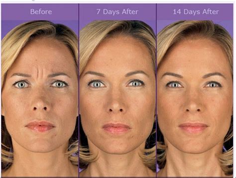 Before And After Botox Injection Acnescarsbeforeandafter Botox