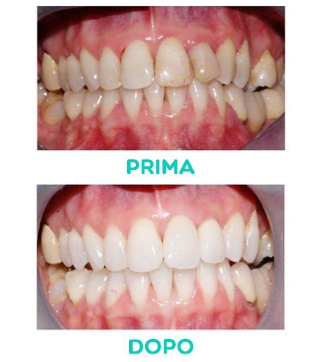 Sbiancamento Dentale Studi Dentistici Nicola Paoleschi