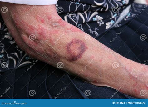 Bruising And Sceriosis Stock Image Image Of Bruising 3214423