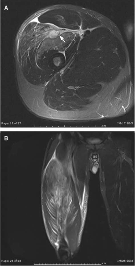 Muscle Contusion Axial A And Coronal B Stir Images Short Ti