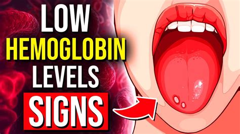 9 Alarming Signs Of Low Hemoglobin You Cannot Ignore Youtube