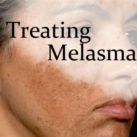 Melasma Treatment Laser Treatment For Skincare Dr Sin Yong