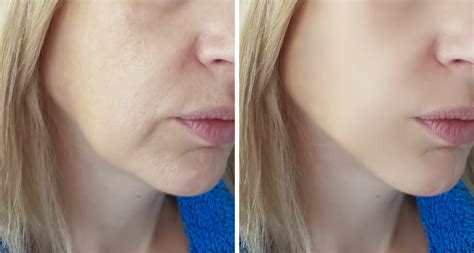 Cosmetic Fillers Advanced Dermatology Of The Midlands Omaha