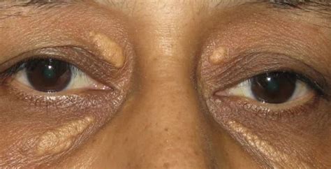 White Spots Under Eyes That Are Not Milia Causes Skincarederm