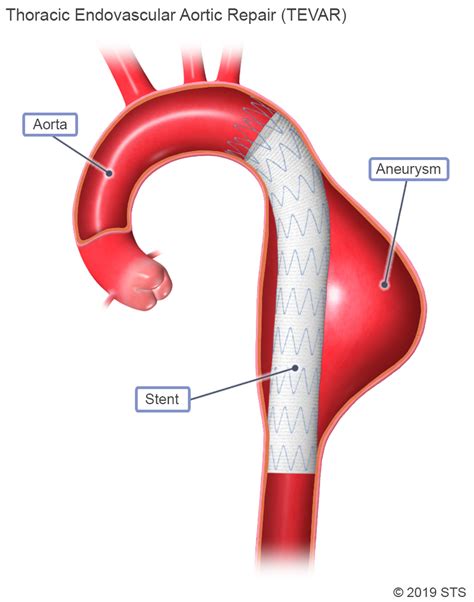 Thoracic Aortic Aneurysm Newport Cardiac Thoracic Surgery