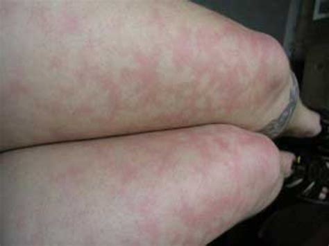 what causes blotchy skin on legs youmemindbody