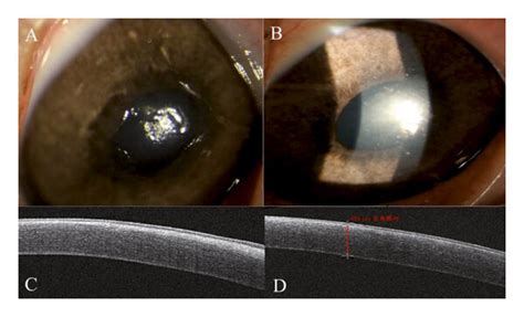 At The 1st Postoperative Week A In The Sbprk Group The Cornea Of