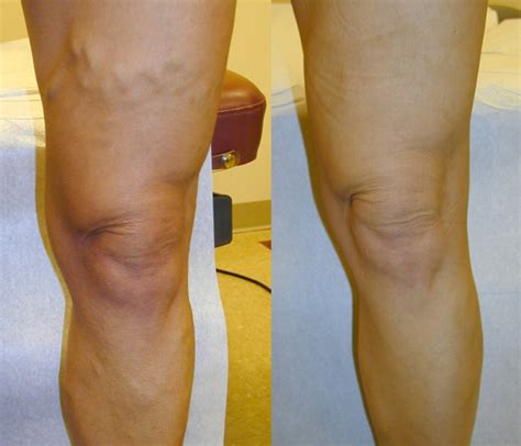 Radiofrequency Venous Ablation Treatment Of Veins St Louis Laser Vein