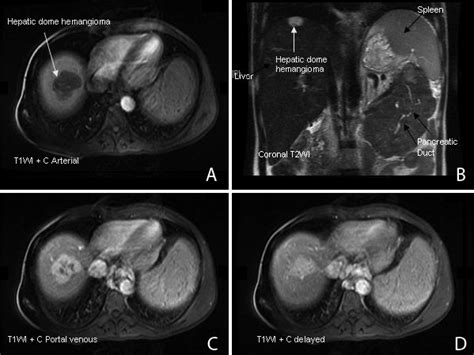 A D Mri Shows A T1 Hypointense And B T2 Hyperintense Hepatic Dome