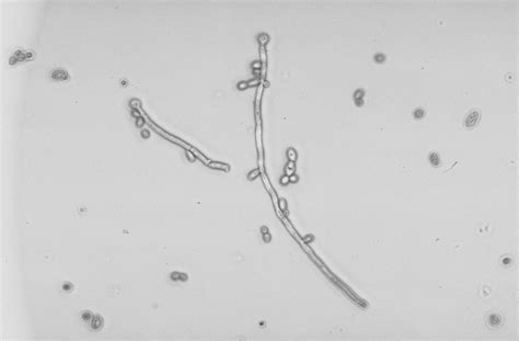 The infection can happen to anyone at any age. Candida Non Albicans In Urine - Yeast Infection and ...