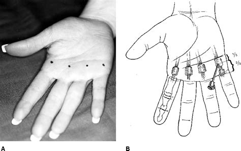 Figure 1 From Trigger Digits Diagnosis And Treatment Semantic Scholar