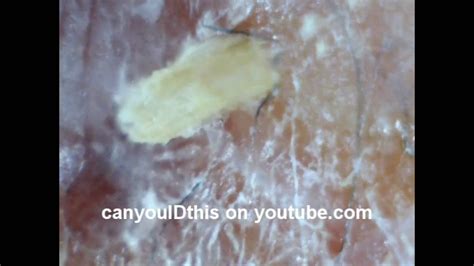 Id This Skin Infection Parasite Nematode Fungus Mrsa Bacterial Youtube