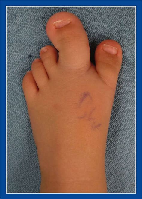 Toesforefoot Foot Malformations Principles And Management Of