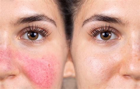 Skincare Tips For Rosacea Prone Skin Reserve Dermatology And Aesthetics