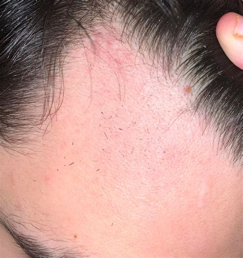 Does This Mole On My Scalp Look Normal I Never Noticed It Before But
