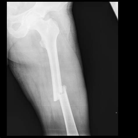 Orthopaedic Surgery For Fractures And Trauma