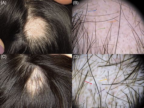 Clinical And Dermoscopic Findings In Aa Lesion Before And After