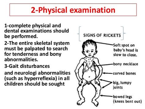 Approach To A Child With Rickets