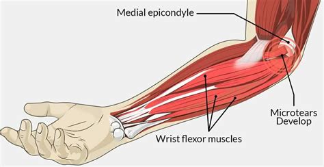 Elbow Pain From Weight Lifting Titaniumphysique