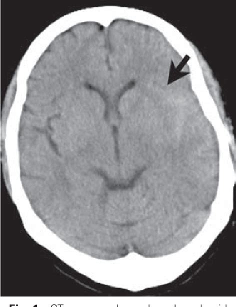 Figure 1 From Non Aneurysmal Subarachnoid Hemorrhage And Consequent