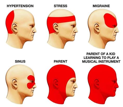 Different Headache Types Chart