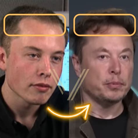 Elon Musks Hair Transplant Before And After Transformation