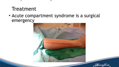 Moeller Chronic Exertional Compartment Syndrome Youtube