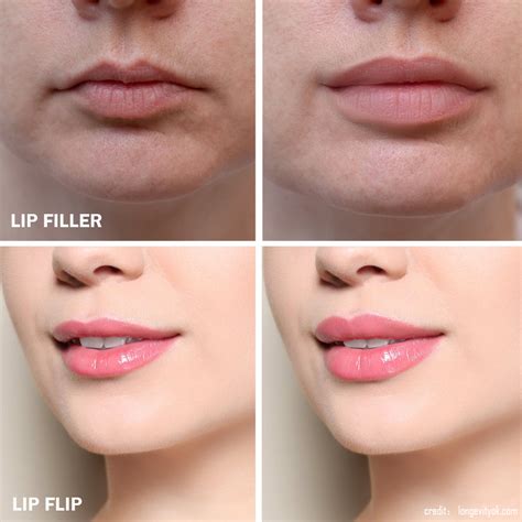 How To Choose Between A Lip Flip And Lip Fillers Her Style Code