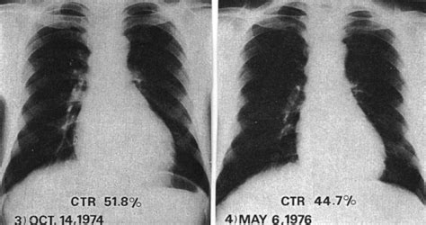 Chest X Ray Of A Patient With Beriberi Before And Afte Open I