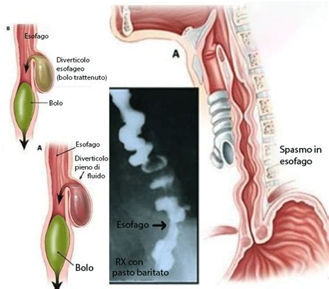 Diverticoli Esofagei Tutto Quello Che Devi Sapere MedicinaGram