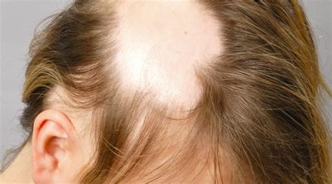 Todo Sobre La Alopecia Femenina Y Sus Tratamientos Va A Gustarme