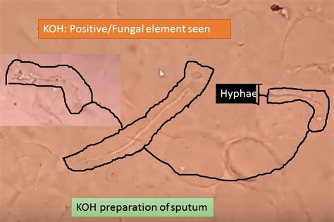 KOH Preparation Of Sputum Showing Fungal Elements Introduction