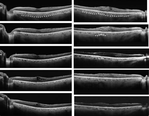 Swept Source Optical Coherence Tomography Correlations Between Retina