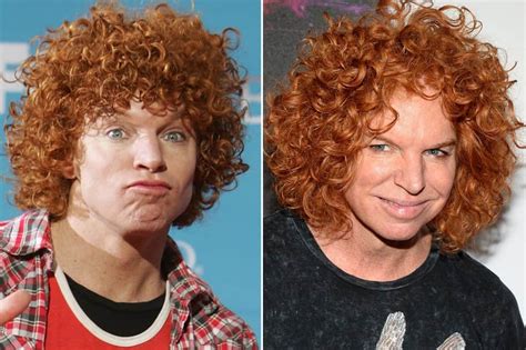 Worst Cases Of Celebrity Plastic Surgery Gone Wrong Hot Sex Picture