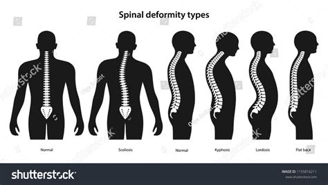 1 827 Spinal Deformities Images Stock Photos Vectors Shutterstock
