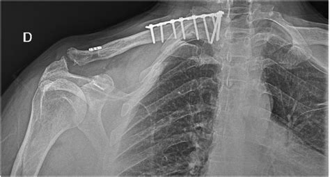 Radiological Control At 4 Month Follow Up Showing Proximal Clavicle