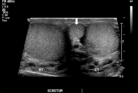 The Sonographic Appearance Of Polyorchidism A Multiple Case Report Eric S Schafer 2019