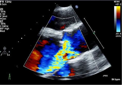Unicuspid Aortic Valve Presenting With Cardiac Arrest In An Adolescent