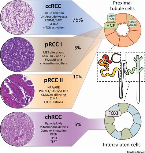 Tracing Renal Cell Carcinomas Back To The Nephron Trends In Cancer