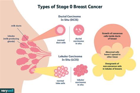 Breast Cancer Types Symptoms Diagnosis Treatment Pmcc Denver Oncology Denver Concierge