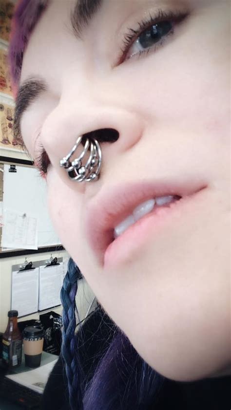 Multiple Rings In Stretched Septum Stretched